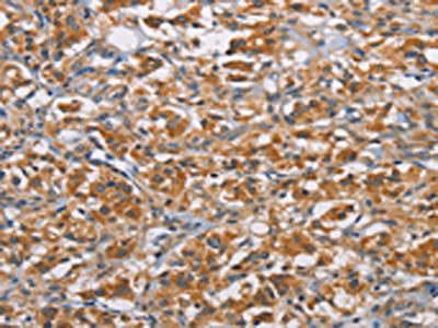 The image on the left is immunohistochemistry of paraffin-embedded Human thyroid cancer tissue using CSB-PA108659(RICTOR Antibody) at dilution 1/40, on the right is treated with fusion protein. (Original magnification: ×200)