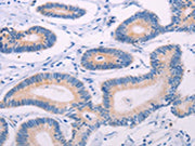 The image on the left is immunohistochemistry of paraffin-embedded Human colon cancer tissue using CSB-PA108827(TEKT4 Antibody) at dilution 1/20, on the right is treated with fusion protein. (Original magnification: ×200)