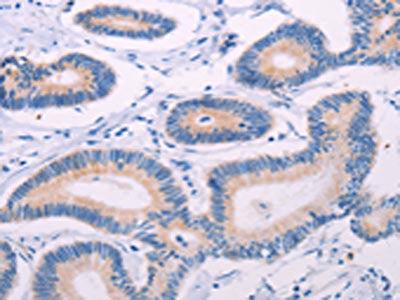 The image on the left is immunohistochemistry of paraffin-embedded Human colon cancer tissue using CSB-PA108827(TEKT4 Antibody) at dilution 1/20, on the right is treated with fusion protein. (Original magnification: ×200)