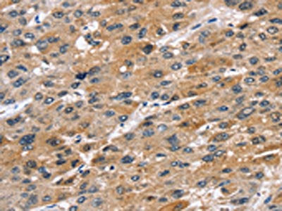 The image on the left is immunohistochemistry of paraffin-embedded Human liver cancer tissue using CSB-PA108943(STK33 Antibody) at dilution 1/45, on the right is treated with fusion protein. (Original magnification: ×200)