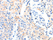 The image on the left is immunohistochemistry of paraffin-embedded Human cervical cancer tissue using CSB-PA108949(GAS6 Antibody) at dilution 1/8, on the right is treated with synthetic peptide. (Original magnification: ×200)
