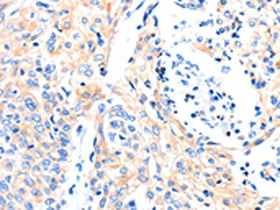 The image on the left is immunohistochemistry of paraffin-embedded Human cervical cancer tissue using CSB-PA108949(GAS6 Antibody) at dilution 1/8, on the right is treated with synthetic peptide. (Original magnification: ×200)