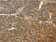 The image on the left is immunohistochemistry of paraffin-embedded Human liver cancer tissue using CSB-PA108957(TNFSF13B Antibody) at dilution 1/30, on the right is treated with fusion protein. (Original magnification: ×200)