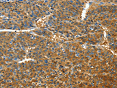 The image on the left is immunohistochemistry of paraffin-embedded Human liver cancer tissue using CSB-PA108957(TNFSF13B Antibody) at dilution 1/30, on the right is treated with fusion protein. (Original magnification: ×200)