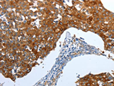 The image on the left is immunohistochemistry of paraffin-embedded Human breast cancer tissue using CSB-PA109108(CEACAM5 Antibody) at dilution 1/25, on the right is treated with synthetic peptide. (Original magnification: ×200)