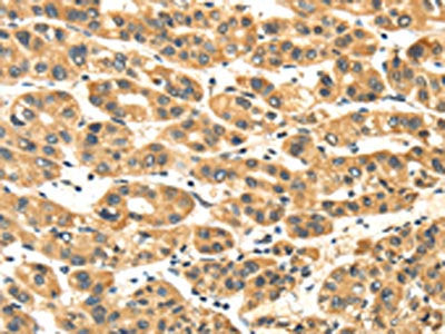 The image on the left is immunohistochemistry of paraffin-embedded Human liver cancer tissue using CSB-PA109162(NME8 Antibody) at dilution 1/45, on the right is treated with fusion protein. (Original magnification: ×200)