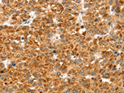 The image on the left is immunohistochemistry of paraffin-embedded Human liver cancer tissue using CSB-PA109166(CCS Antibody) at dilution 1/35, on the right is treated with synthetic peptide. (Original magnification: ×200)