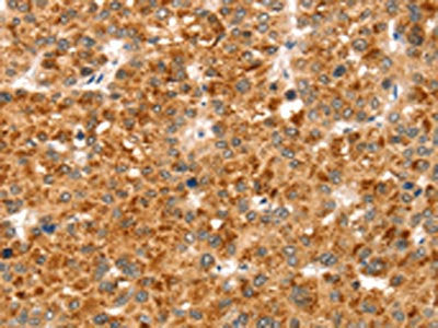 The image on the left is immunohistochemistry of paraffin-embedded Human liver cancer tissue using CSB-PA109166(CCS Antibody) at dilution 1/35, on the right is treated with synthetic peptide. (Original magnification: ×200)