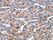 The image on the left is immunohistochemistry of paraffin-embedded Human liver cancer tissue using CSB-PA109226(RPL11 Antibody) at dilution 1/20, on the right is treated with fusion protein. (Original magnification: ×200)