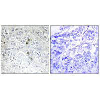 Immunohistochemistry analysis of paraffin-embedded human breast carcinoma tissue, using BATF antibody.