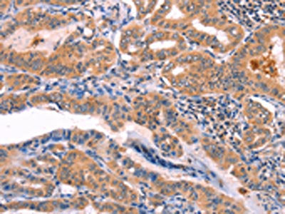 The image on the left is immunohistochemistry of paraffin-embedded Human thyroid cancer tissue using CSB-PA109556(NCEH1 Antibody) at dilution 1/80, on the right is treated with fusion protein. (Original magnification: ×200)