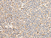 The image on the left is immunohistochemistry of paraffin-embedded Human liver cancer tissue using CSB-PA109581(VPS41 Antibody) at dilution 1/25, on the right is treated with fusion protein. (Original magnification: ×200)