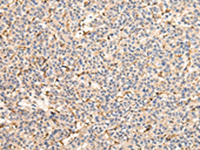 The image on the left is immunohistochemistry of paraffin-embedded Human liver cancer tissue using CSB-PA109581(VPS41 Antibody) at dilution 1/25, on the right is treated with fusion protein. (Original magnification: ×200)