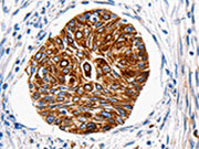 The image is immunohistochemistry of paraffin-embedded Human cervical cancer tissue using CSB-PA109594(HTR1A Antibody) at dilution 1/100. (Original magnification: ×200)