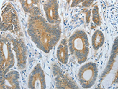 The image on the left is immunohistochemistry of paraffin-embedded Human colon cancer tissue using CSB-PA109707(DNAJC3 Antibody) at dilution 1/30, on the right is treated with fusion protein. (Original magnification: ×200)