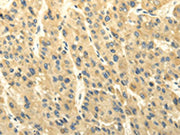 The image on the left is immunohistochemistry of paraffin-embedded Human liver cancer tissue using CSB-PA109776(ABCB7 Antibody) at dilution 1/20, on the right is treated with fusion protein. (Original magnification: ×200)