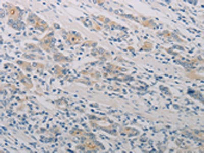 The image on the left is immunohistochemistry of paraffin-embedded Human gastic cancer tissue using CSB-PA109839(PTAFR Antibody) at dilution 1/70, on the right is treated with synthetic peptide. (Original magnification: ×200)