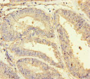 Immunohistochemistry of paraffin-embedded human endometrial cancer using CSB-PA10989A0Rb at dilution of 1:100