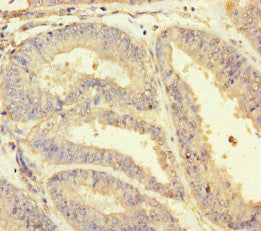 Immunohistochemistry of paraffin-embedded human endometrial cancer using CSB-PA10989A0Rb at dilution of 1:100