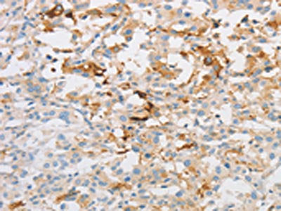 The image on the left is immunohistochemistry of paraffin-embedded Human thyroid cancer tissue using CSB-PA110084(OLFM1 Antibody) at dilution 1/30, on the right is treated with fusion protein. (Original magnification: ×200)