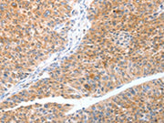 The image on the left is immunohistochemistry of paraffin-embedded Human liver cancer tissue using CSB-PA110146(TRAF3IP3 Antibody) at dilution 1/20, on the right is treated with fusion protein. (Original magnification: ×200)