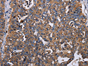 The image on the left is immunohistochemistry of paraffin-embedded Human ovarian cancer tissue using CSB-PA110299(TRIM13 Antibody) at dilution 1/30, on the right is treated with fusion protein. (Original magnification: ×200)