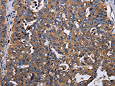The image on the left is immunohistochemistry of paraffin-embedded Human ovarian cancer tissue using CSB-PA110299(TRIM13 Antibody) at dilution 1/30, on the right is treated with fusion protein. (Original magnification: ×200)