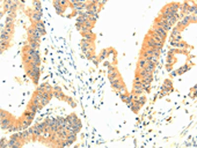 The image on the left is immunohistochemistry of paraffin-embedded Human colon cancer tissue using CSB-PA110310(TERF1 Antibody) at dilution 1/30, on the right is treated with fusion protein. (Original magnification: ×200)