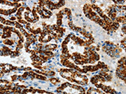 The image on the left is immunohistochemistry of paraffin-embedded Human thyroid cancer tissue using CSB-PA110327(ASB4 Antibody) at dilution 1/40, on the right is treated with fusion protein. (Original magnification: ×200)