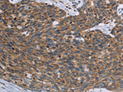 The image on the left is immunohistochemistry of paraffin-embedded Human cervical cancer tissue using CSB-PA110478(TNPO1 Antibody) at dilution 1/25, on the right is treated with synthetic peptide. (Original magnification: ×200)