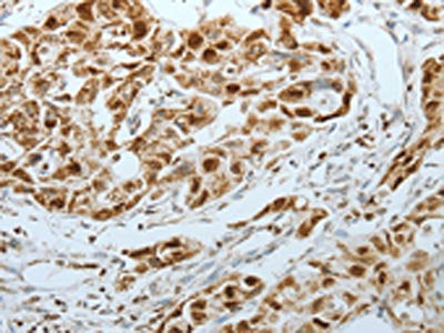 The image on the left is immunohistochemistry of paraffin-embedded Human lung cancer tissue using CSB-PA110553(MCM3 Antibody) at dilution 1/25, on the right is treated with fusion protein. (Original magnification: ×200)