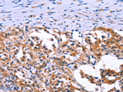 The image on the left is immunohistochemistry of paraffin-embedded Human thyroid cancer tissue using CSB-PA110575(ANO1 Antibody) at dilution 1/40, on the right is treated with synthetic peptide. (Original magnification: ×200)