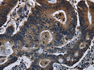 The image on the left is immunohistochemistry of paraffin-embedded Human colon cancer tissue using CSB-PA110763(DHCR7 Antibody) at dilution 1/20, on the right is treated with fusion protein. (Original magnification: ×200)