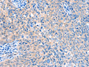 The image on the left is immunohistochemistry of paraffin-embedded Human cervical cancer tissue using CSB-PA110823(ACOX1 Antibody) at dilution 1/20, on the right is treated with fusion protein. (Original magnification: ×200)