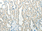 The image on the left is immunohistochemistry of paraffin-embedded Human thyroid cancer tissue using CSB-PA111045(RAB25 Antibody) at dilution 1/50, on the right is treated with synthetic peptide. (Original magnification: ×200)
