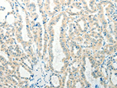 The image on the left is immunohistochemistry of paraffin-embedded Human thyroid cancer tissue using CSB-PA111045(RAB25 Antibody) at dilution 1/50, on the right is treated with synthetic peptide. (Original magnification: ×200)