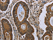 The image on the left is immunohistochemistry of paraffin-embedded Human colon cancer tissue using CSB-PA111065(NEFH Antibody) at dilution 1/40, on the right is treated with synthetic peptide. (Original magnification: ×200)