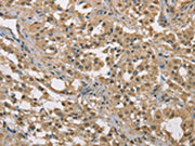 The image on the left is immunohistochemistry of paraffin-embedded Human thyroid cancer tissue using CSB-PA111089(DACH2 Antibody) at dilution 1/40, on the right is treated with fusion protein. (Original magnification: ×200)