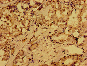 Immunohistochemistry of paraffin-embedded human breast cancer using CSB-PA11109A0Rb at dilution of 1:100