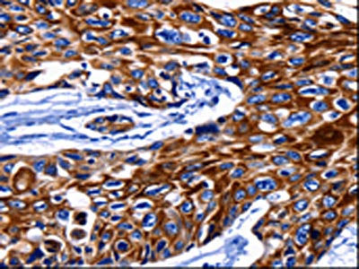 The image on the left is immunohistochemistry of paraffin-embedded Human esophagus cancer tissue using CSB-PA111162(KRT10 Antibody) at dilution 1/25, on the right is treated with synthetic peptide. (Original magnification: ×200)