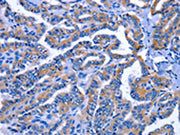 The image on the left is immunohistochemistry of paraffin-embedded Human thyroid cancer tissue using CSB-PA111413(IGSF10 Antibody) at dilution 1/60, on the right is treated with fusion protein. (Original magnification: ×200)