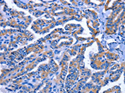 The image on the left is immunohistochemistry of paraffin-embedded Human thyroid cancer tissue using CSB-PA111413(IGSF10 Antibody) at dilution 1/60, on the right is treated with fusion protein. (Original magnification: ×200)