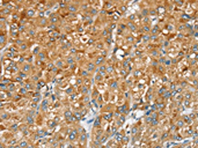 The image on the left is immunohistochemistry of paraffin-embedded Human liver cancer tissue using CSB-PA111655(SERINC2 Antibody) at dilution 1/20, on the right is treated with synthetic peptide. (Original magnification: ×200)