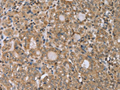 The image on the left is immunohistochemistry of paraffin-embedded Human thyroid cancer tissue using CSB-PA112057(RAB39B Antibody) at dilution 1/45, on the right is treated with synthetic peptide. (Original magnification: ×200)