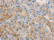 The image on the left is immunohistochemistry of paraffin-embedded Human liver cancer tissue using CSB-PA112219(DIRAS3 Antibody) at dilution 1/25, on the right is treated with fusion protein. (Original magnification: ×200)