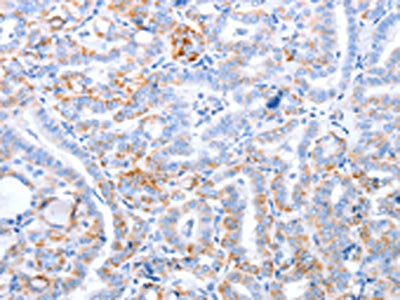The image on the left is immunohistochemistry of paraffin-embedded Human thyroid cancer tissue using CSB-PA112350(TRAF3IP3 Antibody) at dilution 1/25, on the right is treated with fusion protein. (Original magnification: ×200)