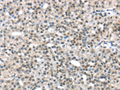 The image on the left is immunohistochemistry of paraffin-embedded Human breast cancer tissue using CSB-PA112642(TRIP6 Antibody) at dilution 1/45, on the right is treated with fusion protein. (Original magnification: ×200)
