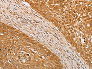 The image on the left is immunohistochemistry of paraffin-embedded Human cervical cancer tissue using CSB-PA112765(STK40 Antibody) at dilution 1/30, on the right is treated with fusion protein. (Original magnification: ×200)
