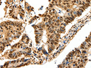 The image on the left is immunohistochemistry of paraffin-embedded Human colon cancer tissue using CSB-PA112925(SSB Antibody) at dilution 1/20, on the right is treated with synthetic peptide. (Original magnification: ×200)