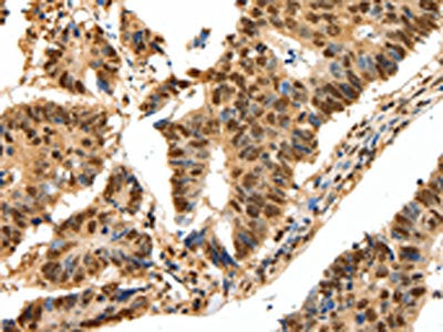 The image on the left is immunohistochemistry of paraffin-embedded Human colon cancer tissue using CSB-PA112925(SSB Antibody) at dilution 1/20, on the right is treated with synthetic peptide. (Original magnification: ×200)